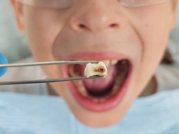 Best Dentist for Tooth Abscess  in Lionville, PA